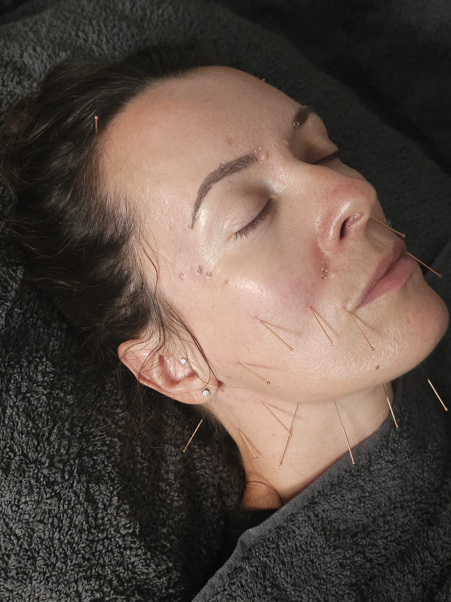 Acupuncture 2
